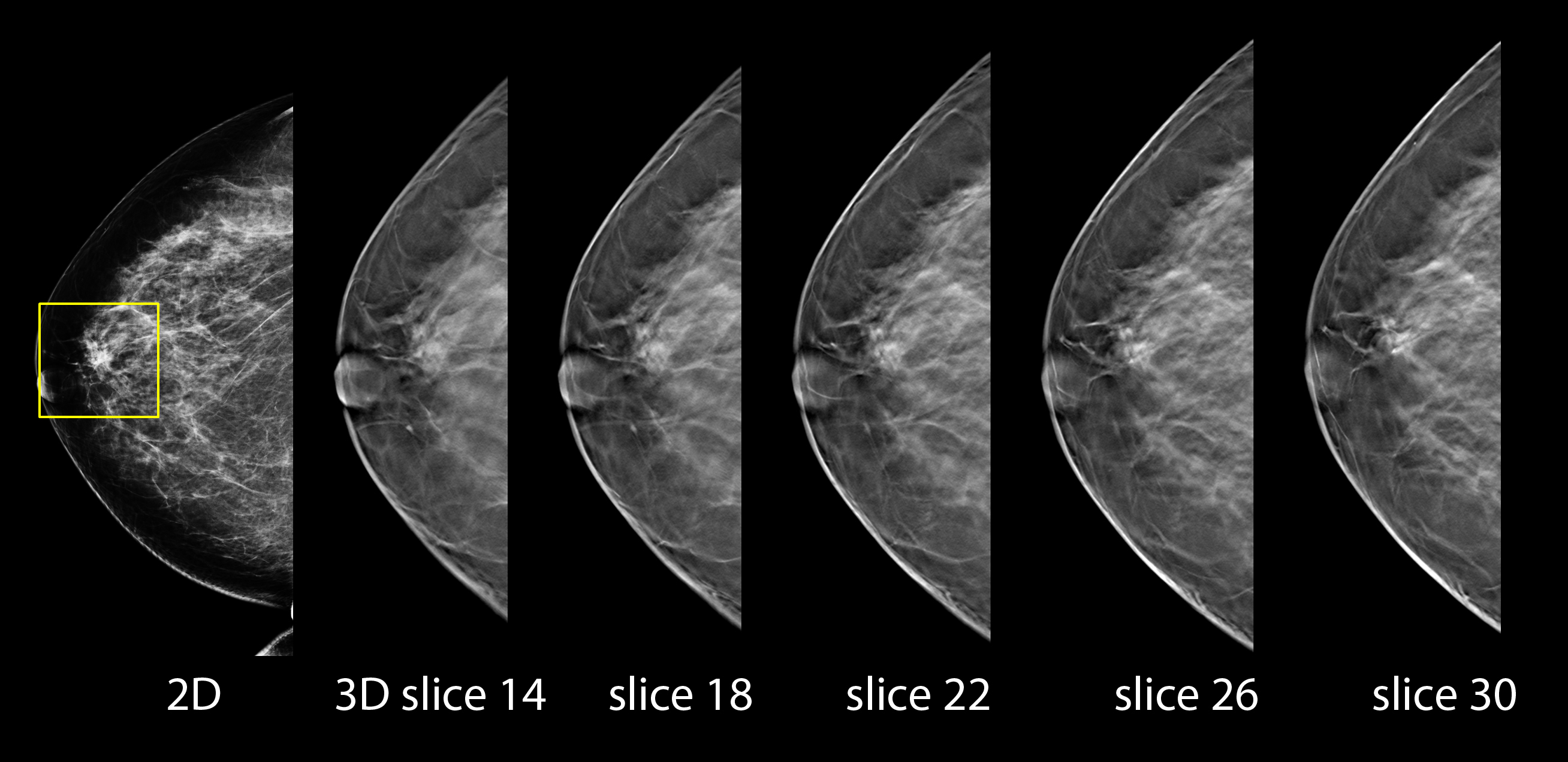 Selenia Dimensions 3d Mammography Hologic 3882